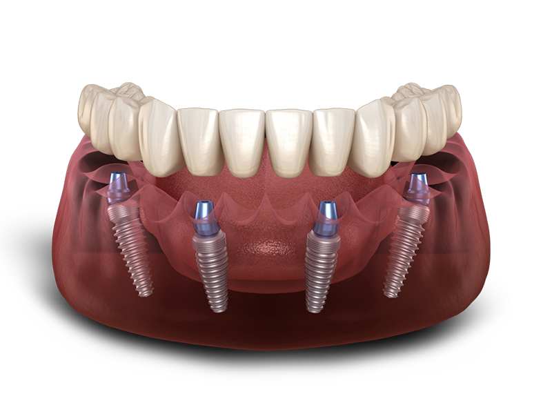 All-On-4® Dental Implant Prosthetic Hovering Over 4 Dental Implants In A Transparent Gumline