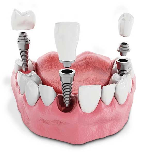 a model that shows three dental implants being placed