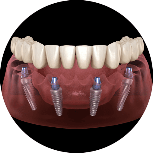 full arch dental implants