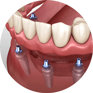 implant supported dentures