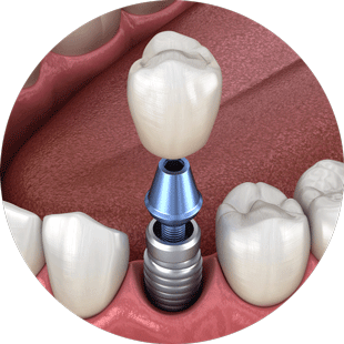 teeth in a day dental implants