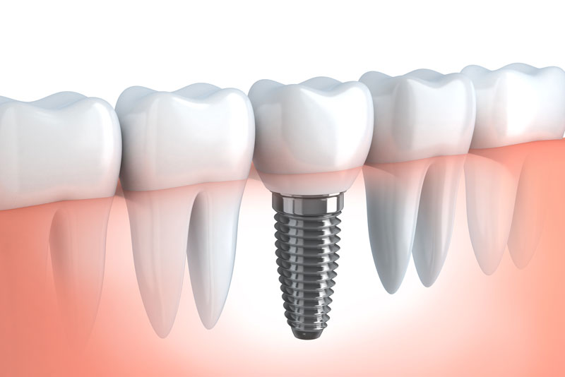 a dental implant placed in the gum line with a titanium post