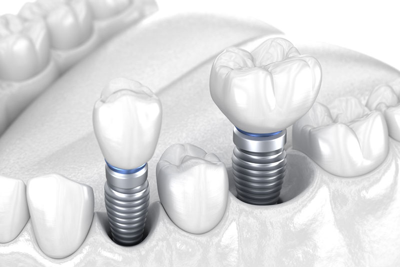 dental implants model showing a few single dental implants