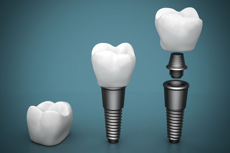 an image of three types of dental implant models