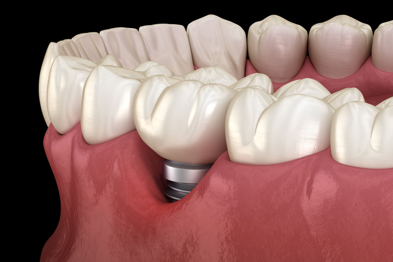 a single dental implant, and the top of its post, shown in the the gums of a dental implant model