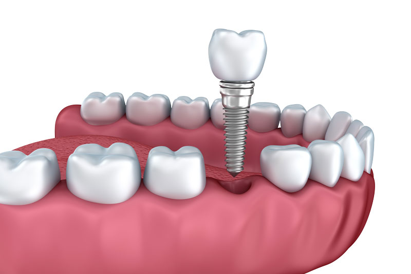 a picture of a single dental implant post being placed in a lower arch dental implant model, surrounded by other teeth.