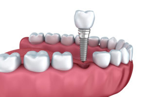 a dental implant hovering over the dental implant model and the surrounding teeth.