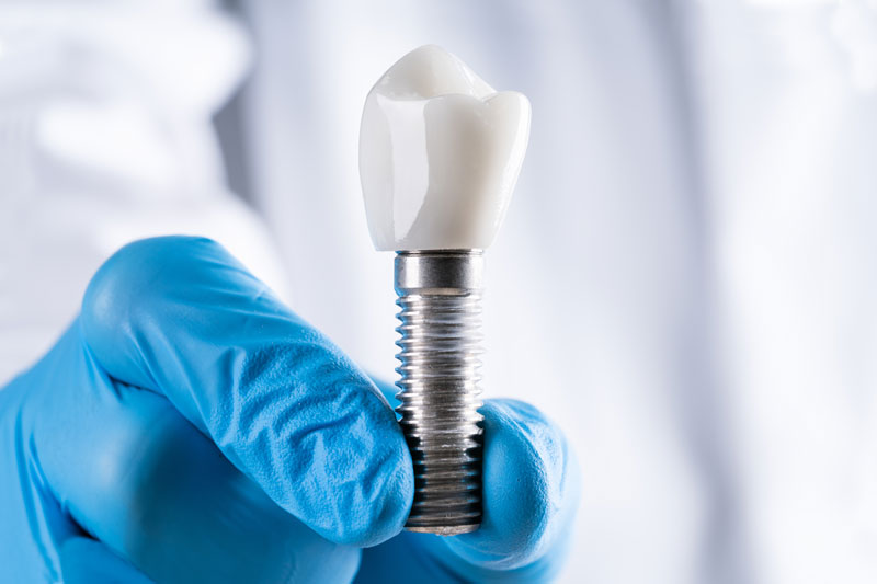 a doctor holding up a single dental implant model to help explain to a patient how same day dental implants work.