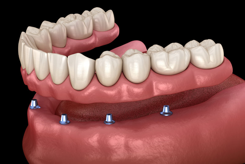 a picture of an implant supported denture model with a black background that shows how the dental implant posts hold the denture that is over it in place.