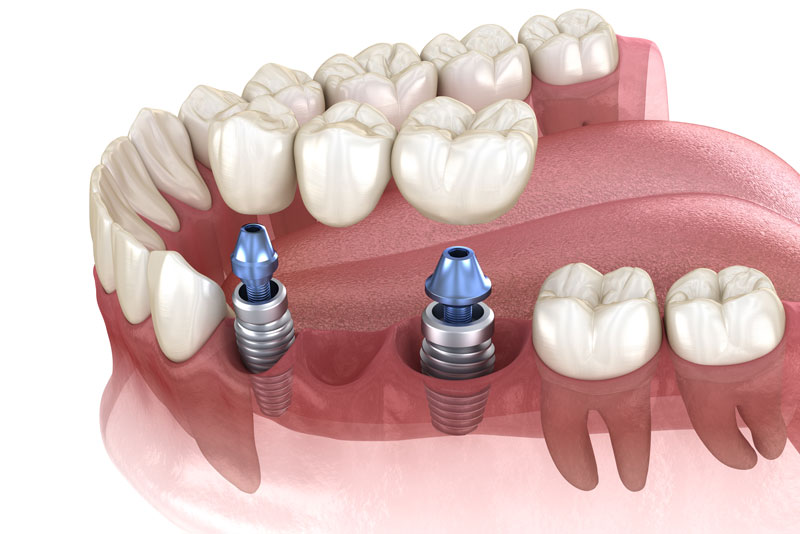 a dental implant bridge being held by two dental implants.