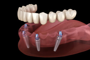 An image of full mouth dental implants.