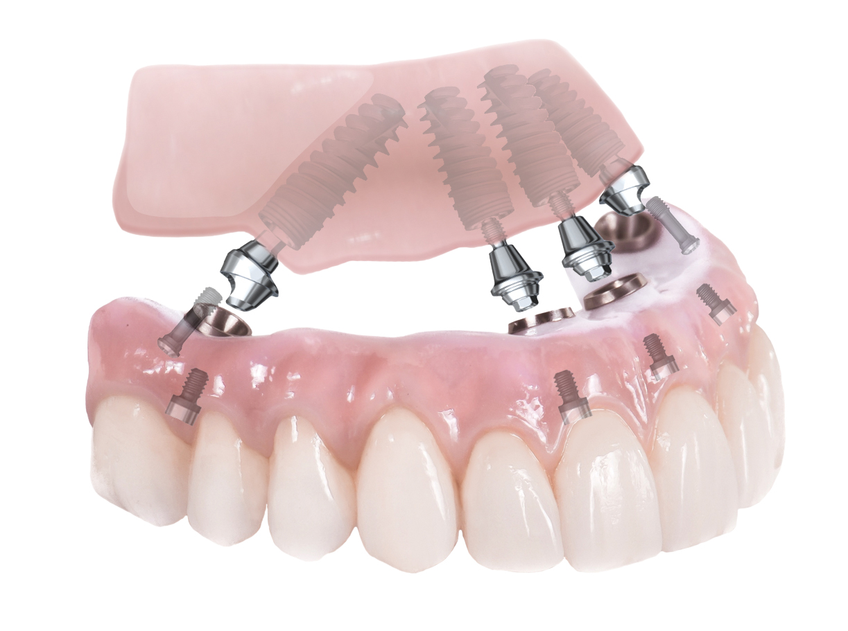 An image of All-On-4-Dental-Implants model.