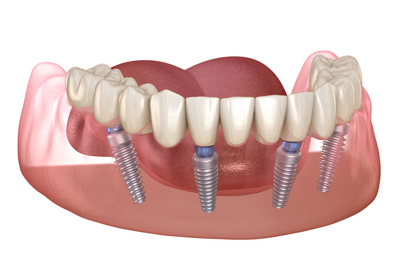 an all-on-4 dental implant model that shows how all-on-4 dental implants benefit patients smiles with just four dental implants supporting a denture.