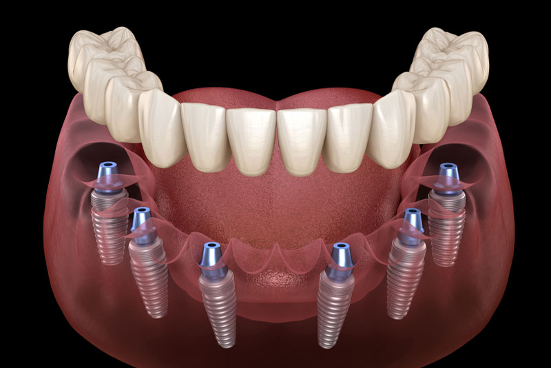 a lower arch full mouth dental implant model that shows how full mouth dental implants are cost-effective because the dental implant posts securely hold the custom made prosthesis in place.