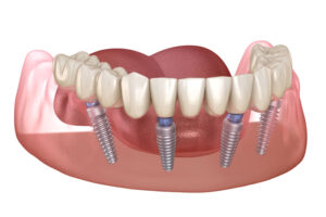 four dental implants ready to securely hold a full arch prosthesis for an all-on-4 dental implant procedure, after preliminary bone grafting and tooth extractions were performed.