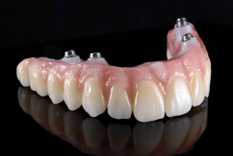 a zirconia fixed bridge for the upper arch that will be securely attached to full mouth dental implants.