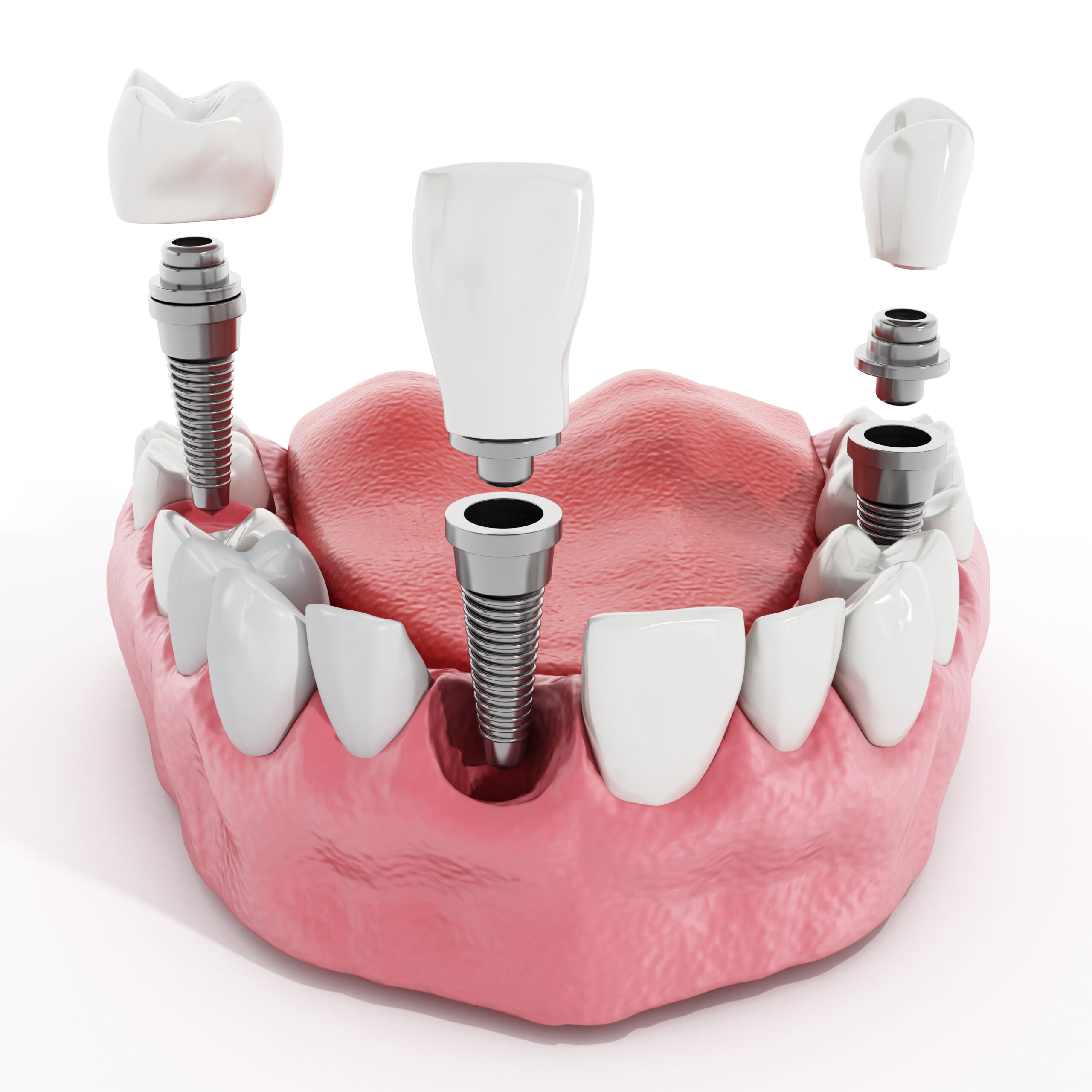 Illustration of teeth showing dental implant structure.